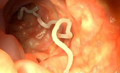przyczyny pasożytów w organizmie człowieka